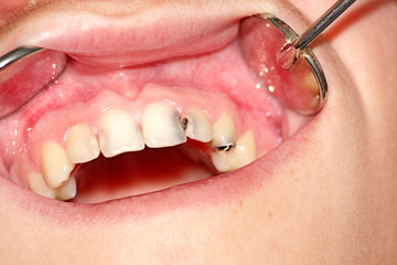 Cavity Treatment