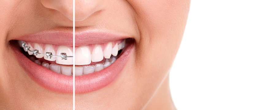 Orthodontics (Braces)